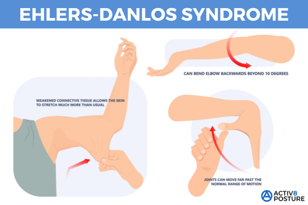 How Chiropractic Care Can Help Those with Ehlers-Danlos Syndrome (EDS), Hypermobility, and ADHD: A Safe, Effective Approach for Restoring Your Full Potential